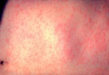 Alerta por aumento de casos de sarampión en el mundo - Itagüí Hoy